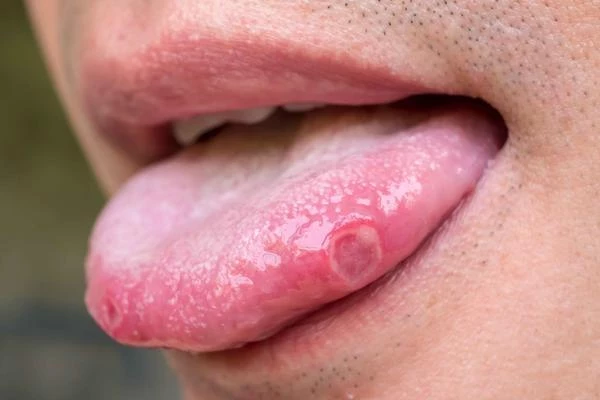 當舌苔有5種異常表現時，可能預示疾病的發生，及時調理