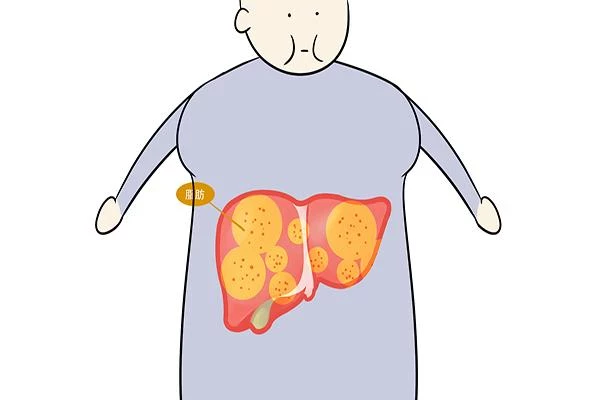 脂肪肝「喜歡」的3件事，趕緊改正，那肝臟「喜歡」什麼食物呢？