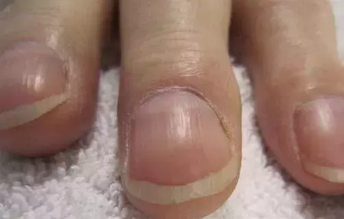 「手指不一樣」小心肺癌來敲門！醫生靠1個動作自測：快看你有沒有 