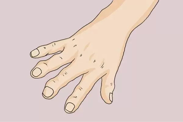 50歲左右女性，早起後手指僵硬，痛得難以活動，是怎麼了？