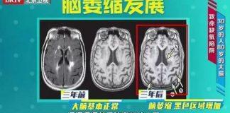 兩個壞習慣加速大腦衰老,很多人卻天天在做!出現這個症狀要小心!