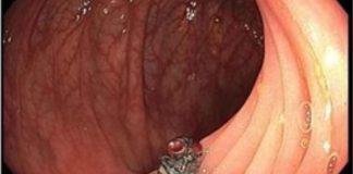 他做大腸鏡檢查…竟照到「有隻活蒼蠅」停在腸壁上!謎之「躲過胃酸」醫生也看傻:在腸道裡孵化