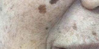 都50歲了!!為何有些人皮膚上的老年斑「密密麻麻」有的卻很乾凈!醫生說出實情