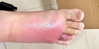 在沙發上光腳睡了一覺,男子腳掌「腫成豬腳」差點截肢!