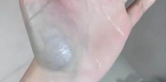 她曬出「手掌瘀青照」納悶問:這顏色正常嗎?網一看「勸快去掛急診」檢查結果讓她腿軟