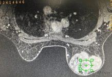 平常不痛不癢!她照X光「驚見全部長滿了」 醫生臉綠「緊急安排手術」:早該重視了
