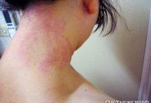 突然全身不舒服!她驚見「脖子被黑手印抓住」 專家愣問「最近是不是吃柚子」沒注意就中標